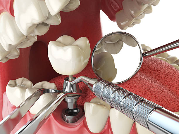 Best Emergency Wisdom Tooth Extraction in Thornville, OH